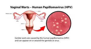 Virus HPV là gì