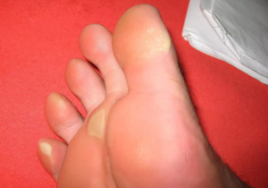 Bàn chân bàn tay bị chai