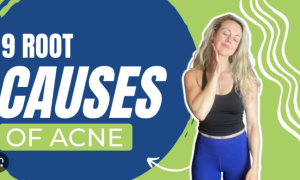 Nguyên nhân gốc rễ của mụn