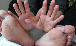 Phân tích bệnh chân tay miệng do virus