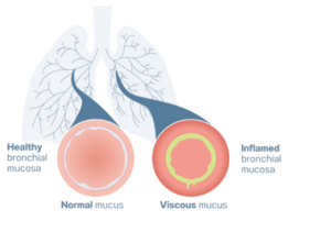 Phân tích nguyên nhân tạo thành đờm