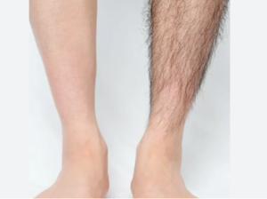 Tại sao người có nhiều lông chân người có ít